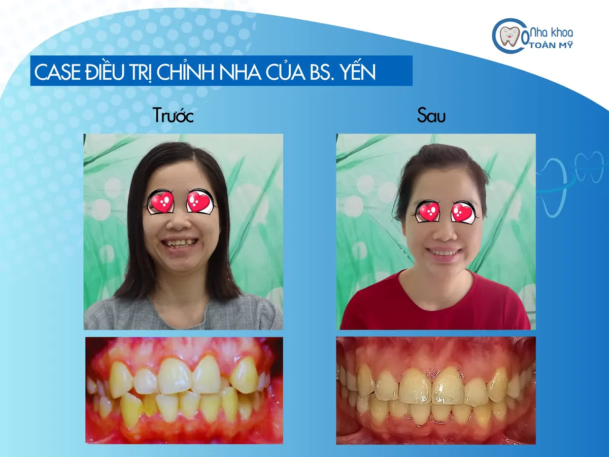 Ca niềng răng khấp khểnh trước và sau điều trị tại Nha khoa Toàn Mỹ