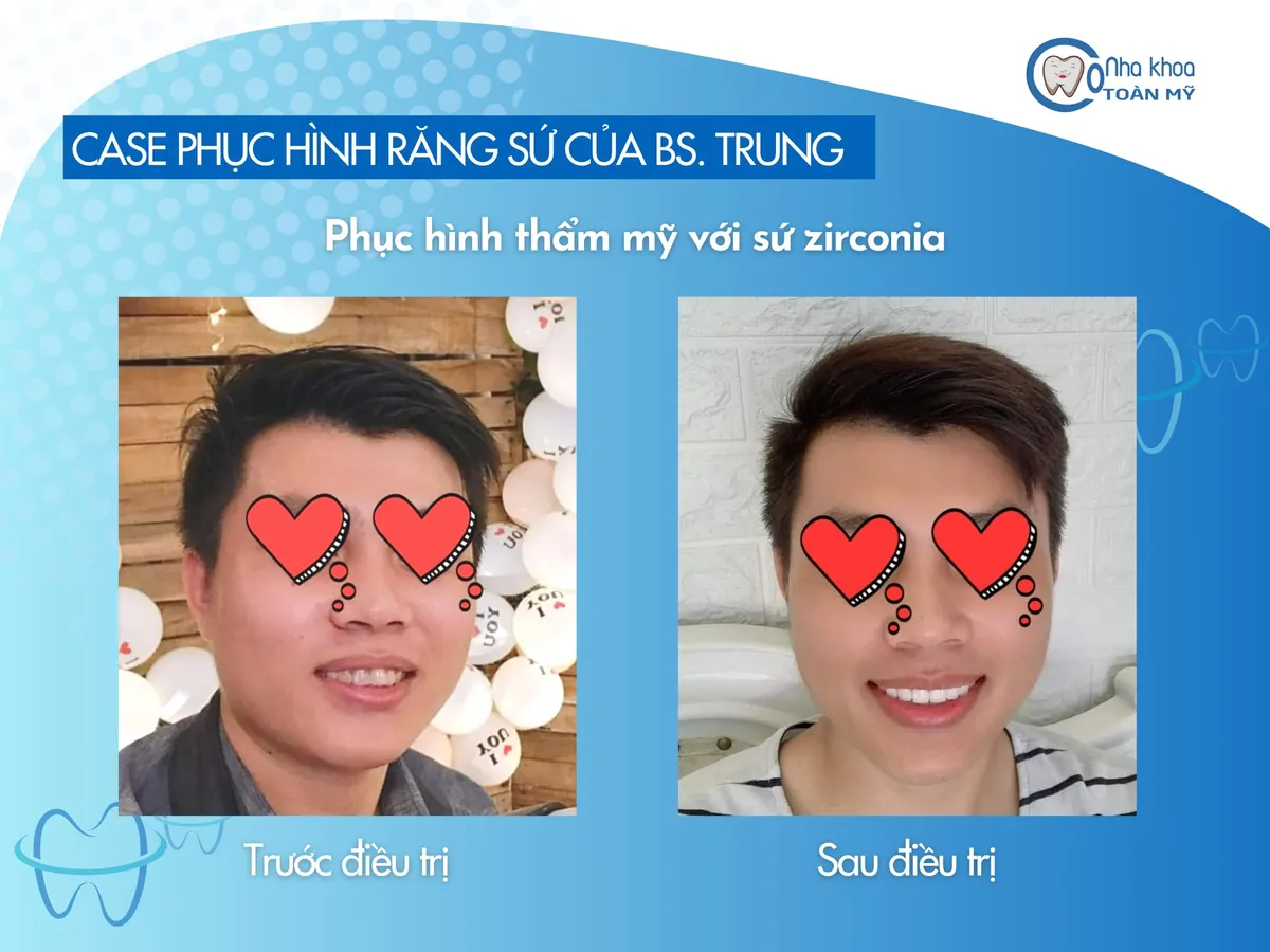 Ca phục hình răng sứ zirconia trước và sau điều trị tại Nha khoa Toàn Mỹ