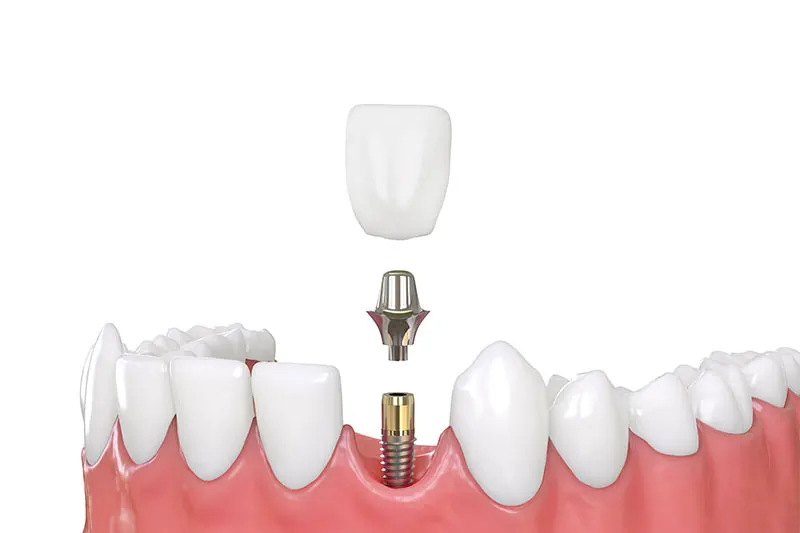 Cấu trúc cấy ghép răng implant gồm trụ titan khớp nối abutment và mão sứ